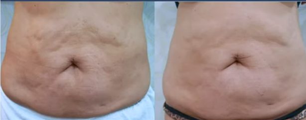 tummy before and after Liposuction