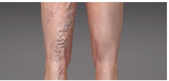 leg with big varicose veins
