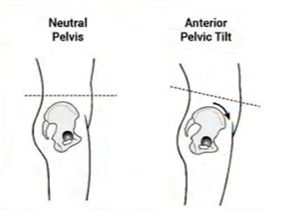neutral pelvis and anterior pelvic tilt